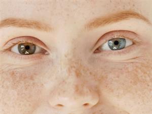 heterochromia person